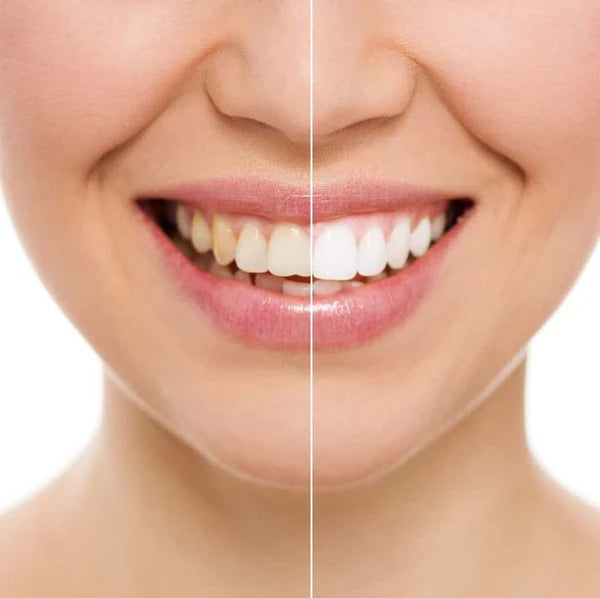 LÁMPARA BLANQUEADORA LED MYSMILE® | RECUPERA TU SONRISA